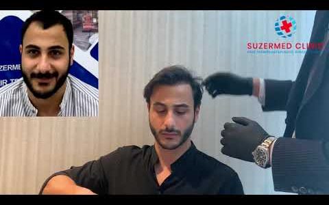 Hair Transplant 1 Year Post-Op Result by Suzermed Clinic
